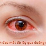 Bệnh đau mắt đỏ lây qua đường nào? Nhìn vào mắt người bệnh có bị lây không?