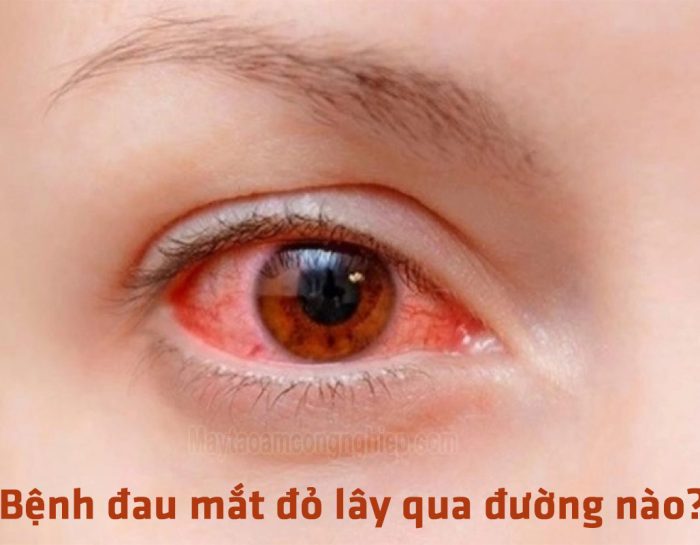 Bệnh đau mắt đỏ lây qua đường nào? Nhìn vào mắt người bệnh có bị lây không?