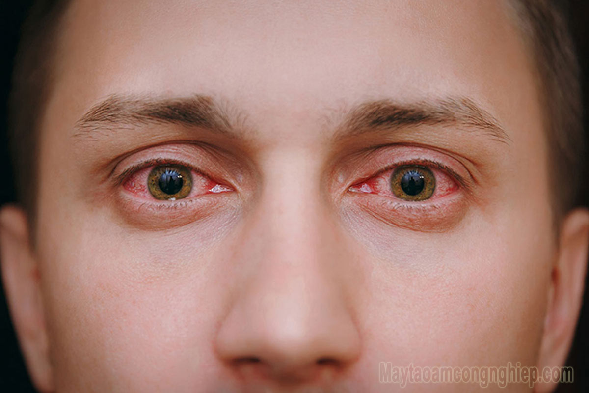 Bị đau mắt đỏ bao lâu thì khỏi? Đau mắt đỏ có tái phát không? Cách giúp đau mắt đỏ nhanh khỏi