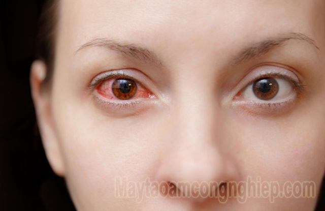 Đau mắt đỏ có thể tự hoàn toàn khỏi