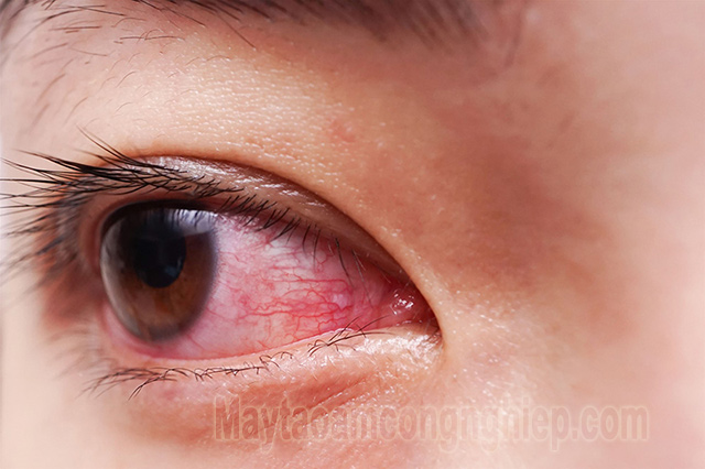 Hiện nay có rất nhiều cách chưa đau mắt đỏ