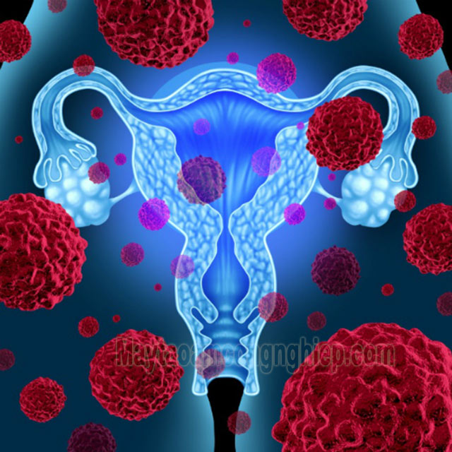 Virus HPV là loại gây ung thư ở cổ tử cung